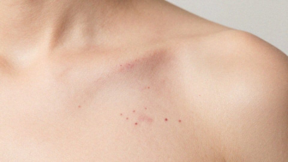 Czy infekcje i choroby hematologiczne dają wybroczyny?