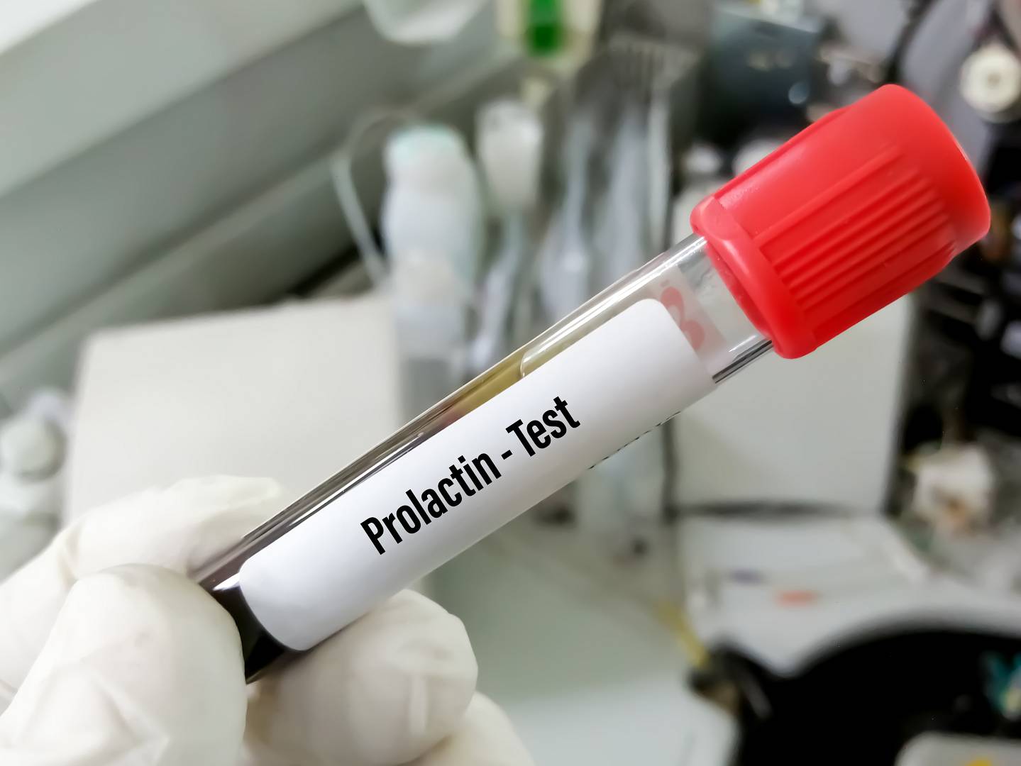 Jakie są najczęstsze przyczyny i objawy wysokiego poziomu prolaktyny u kobiet?